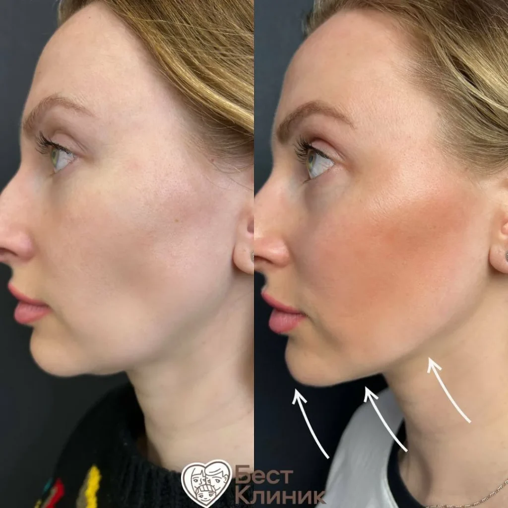 Best Non-Surgical Facelift for Jowls: Cost vs. Benefits