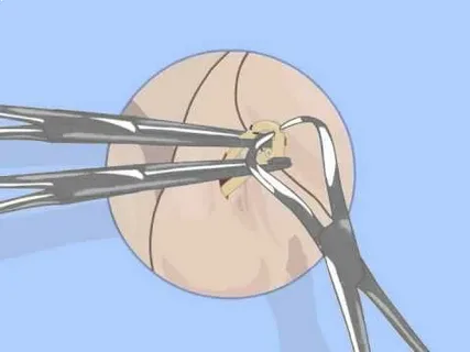 Is No Scalpel Vasectomy NZ Right for You?