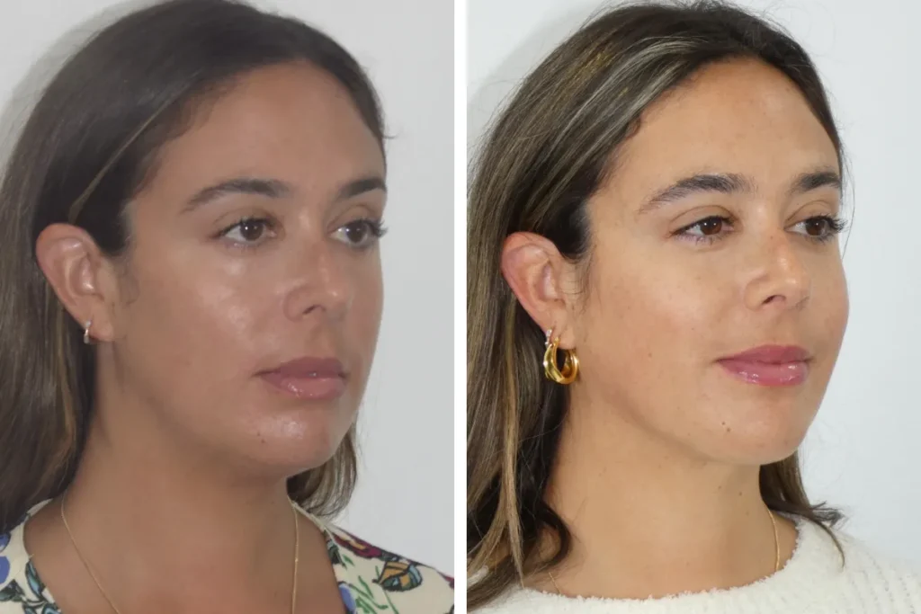 Beyond the Before-and-After Photo: Understanding What Liposuction Can Really Deliver